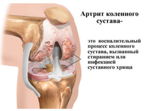 артрит коленного сустава лечение таблетки