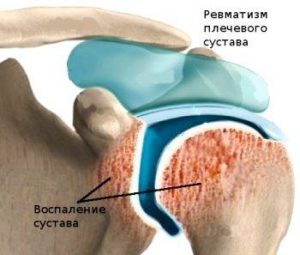 Осложнения и симптомы ревматизма суставов