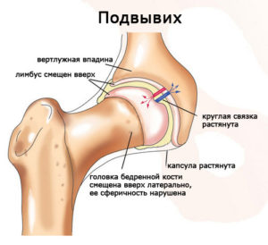 дисплазия тазобедренных суставов стадии