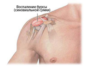 гнойный бурсит 